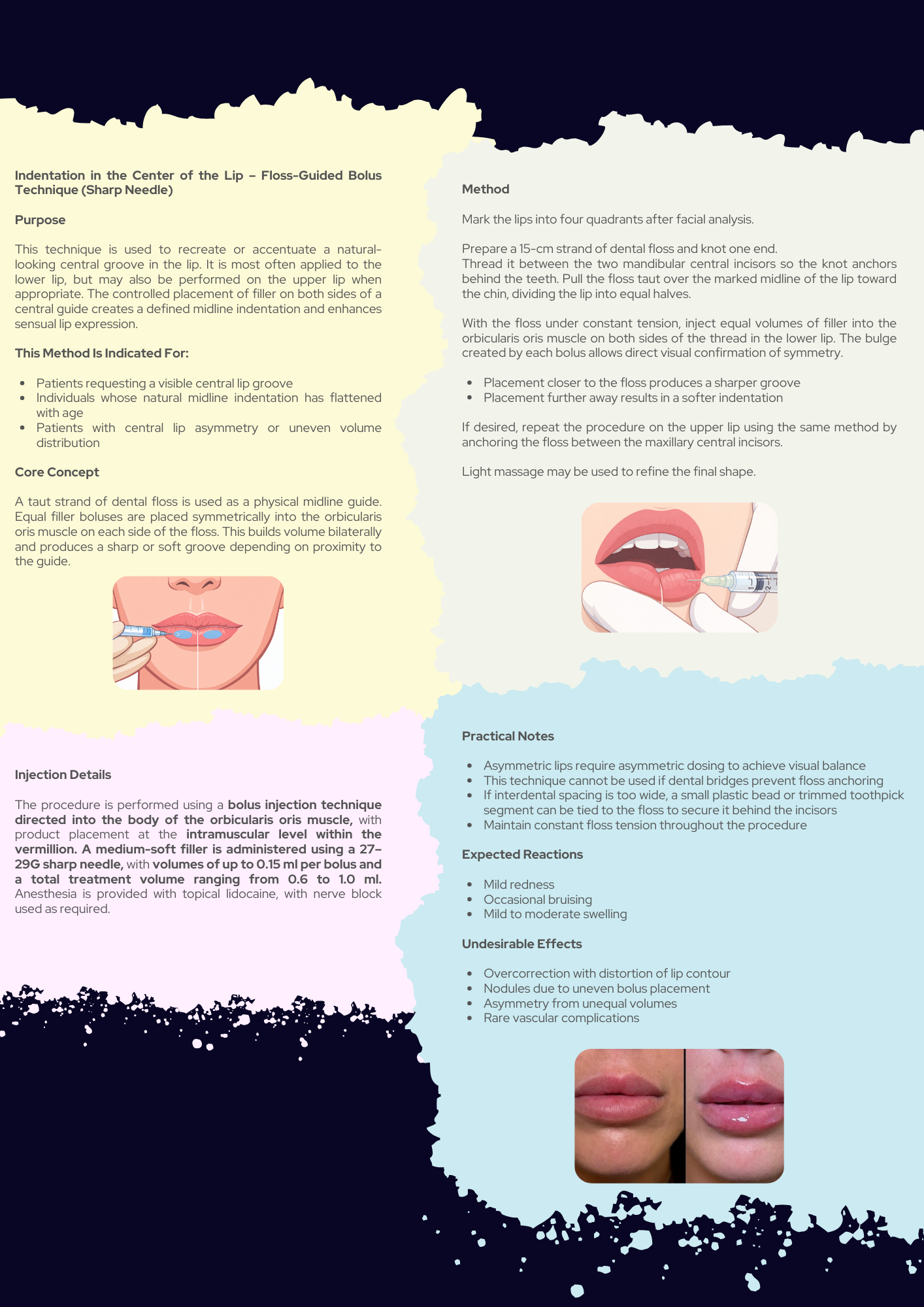 Aesthetic Lip Injections Complete Guidebook PDF
