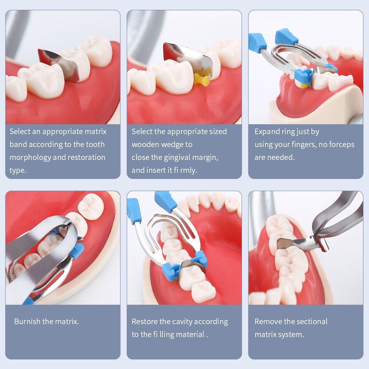 Dental Matrix Sectional Contoured Metal Spring Clip Rings Clamps Wedges.