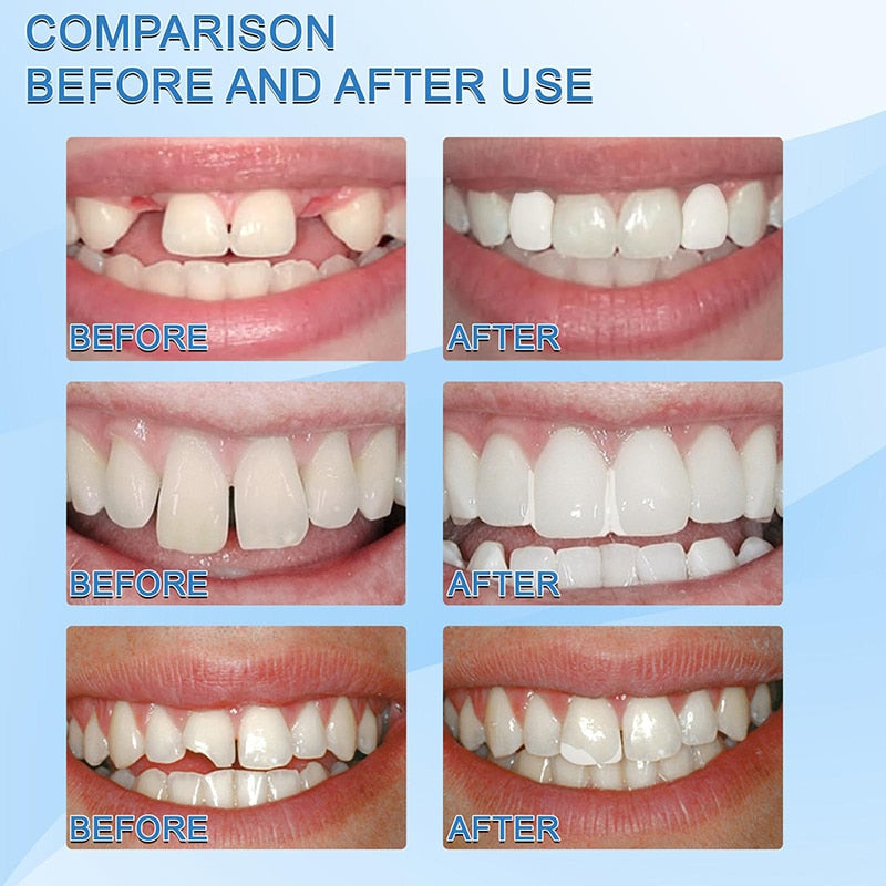 Resin Tooth Repair Glue Shapeable Teeth Gaps Filling